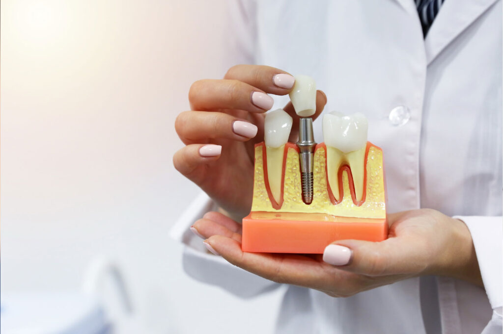 dental implants